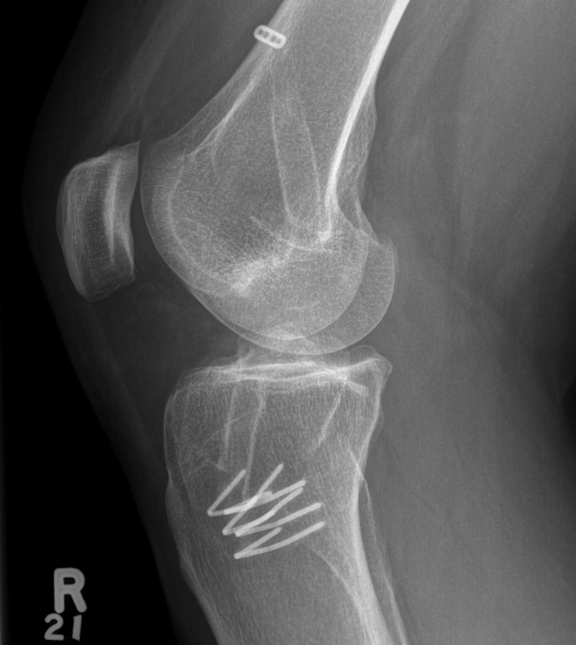 Revision ACL Lateral